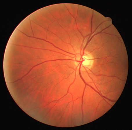 The algorithm developed by Akilan extracts data from a fundus image of the retinal vessels of the eye and classifies abnormalities that can help diagnose Alzheimer's disease.
