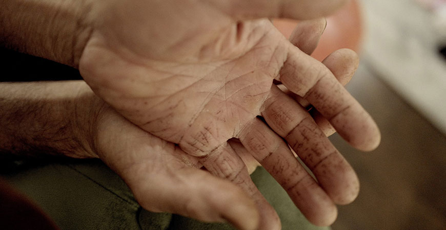 Sharim's father's hands, damaged fieldwork.